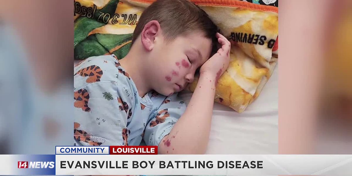 10-year-old Hayden Kissen diagnosed with rare blood vessel disorder HSP [Video]