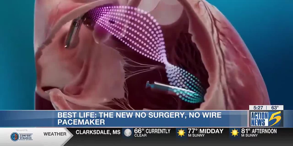 The new No Surgery, No Wires pacemaker [Video]