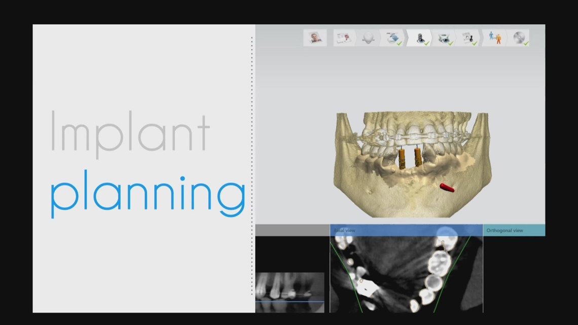 Dentists at UB using artificial intelligence to repair teeth [Video]
